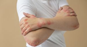 Peligros del herpes zoster