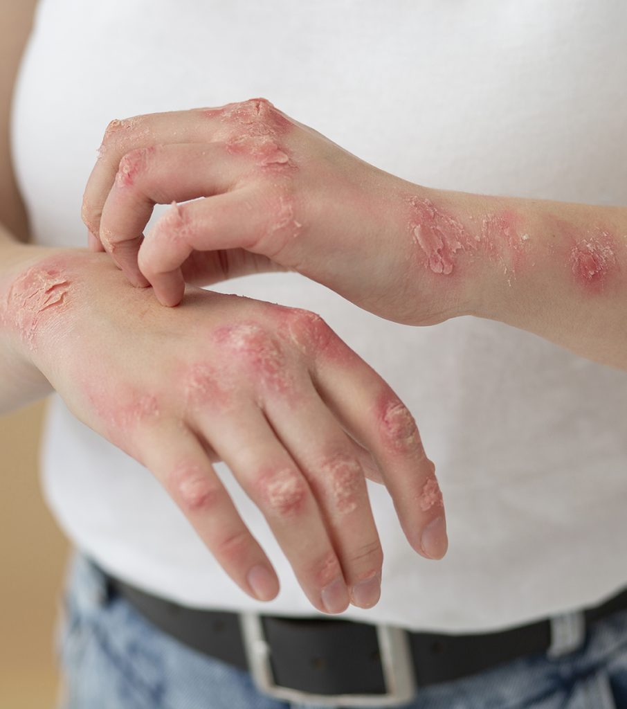 Riesgos y complicaciones del herpes zoster
